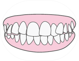 Dientes chuecos
