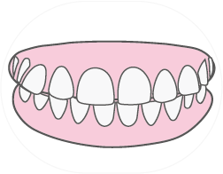Dientes Separados