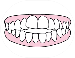 Mordida abierta